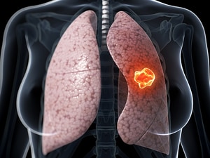 'No Brainer': IMRT for Locally Advanced NSCLC