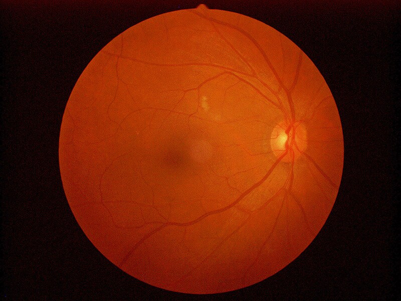 lattice degeneration of retina