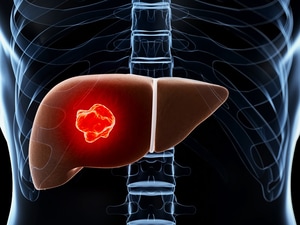 Liver Cancer Found in Hepatitis C Patients on New Antivirals