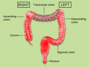 Big Difference in Colorectal Cancer on Right vs Left Side