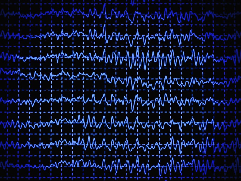 Using EEG to Distinguish Epilepsy From Its Imitators