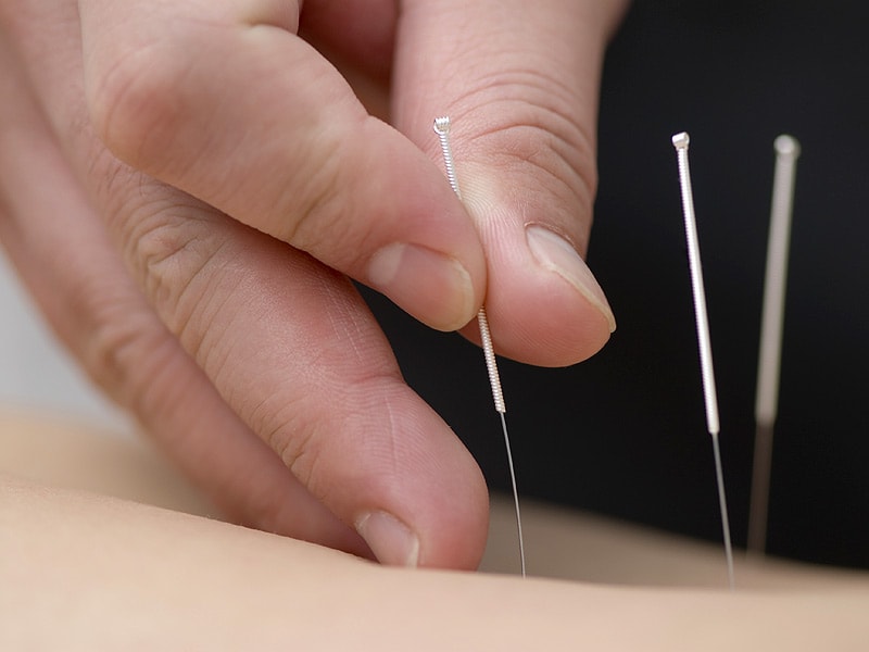 Acupuncture May Improve Memory in Mild Cognitive Impairment