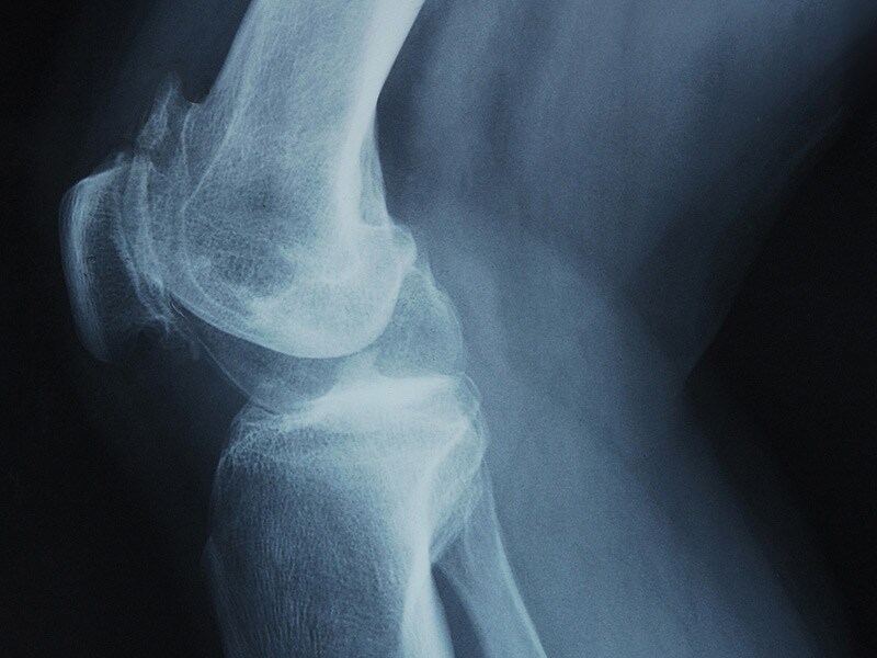 Cryoneurolysis Shows Promise in Treating Knee Arthritis