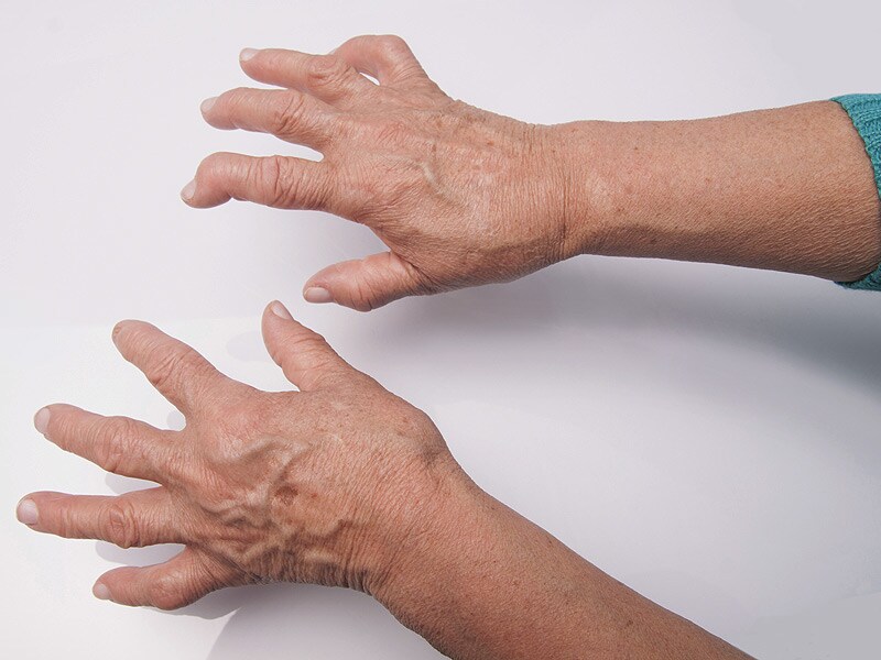 Early Treatment Boosts Long-term Rheumatoid Arthritis Outcomes