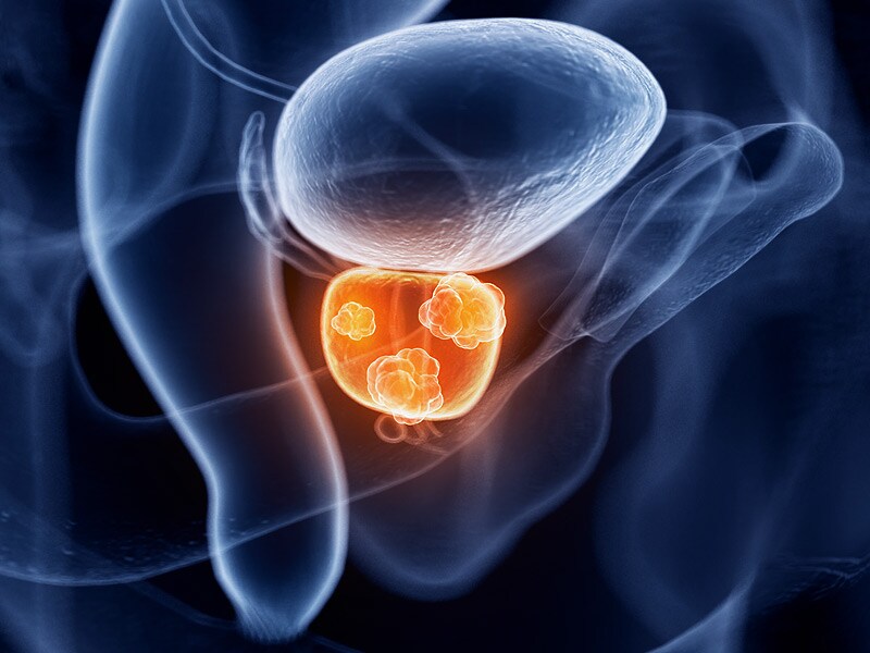 gleason grade 9 prostate cancer