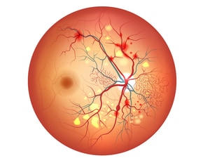 OCT Angiography Can Identify Early Diabetic Retinopathy