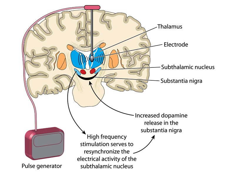 Patient With Parkinsonism, Gene Mutation Improved With DBS