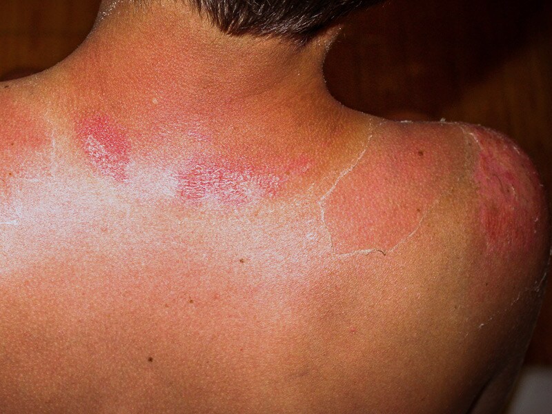 A Post-Stroke Hemorrhagic Rash