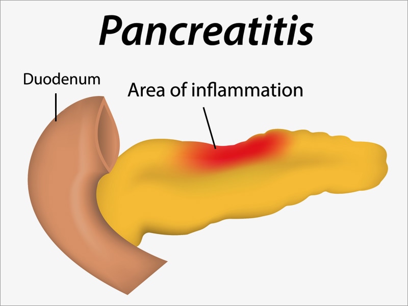 Exocrine Pancreatic Insufficiency