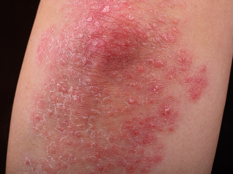 Effective Topical Therapies in the Management of Psoriasis