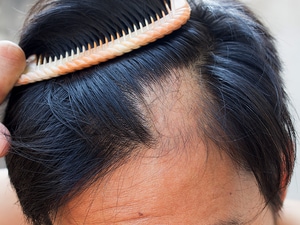 JAK Inhibitors Show Promise for Alopecia, Eczema, Vitiligo