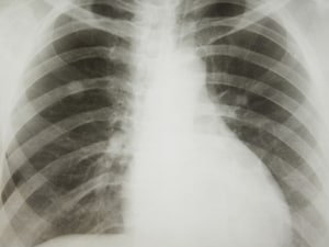 NCCN Updates Lung Cancer Guideline, Again