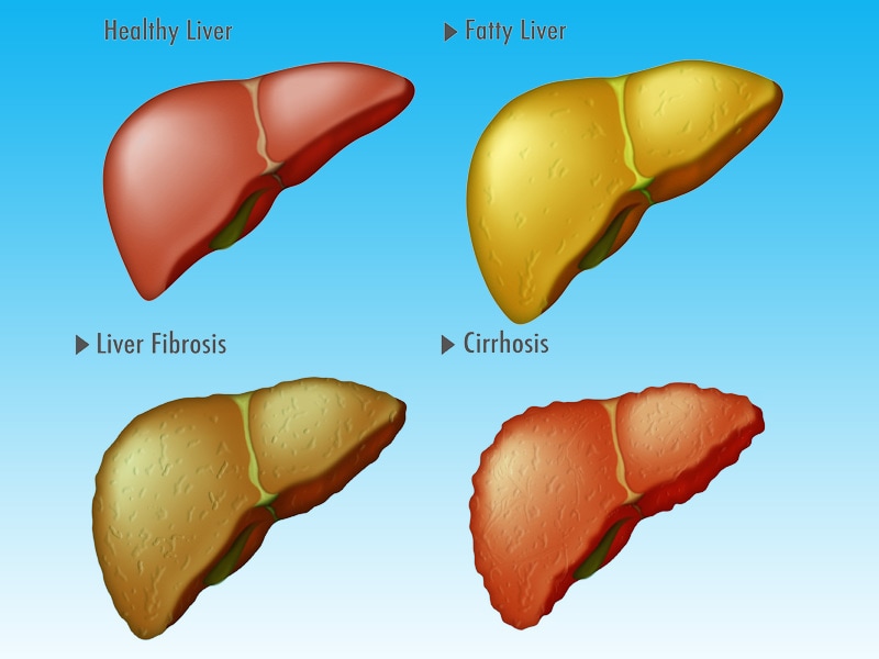 new-system-detects-cirrhosis-in-fatty-liver-disease