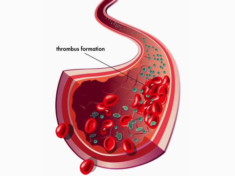 Ovarian Cancer: Clot Risk High In All Phases Of Treatment