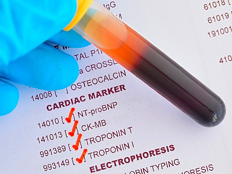 test heart troponin Signal May CVD Troponin Risk Normal High for Fatal Levels