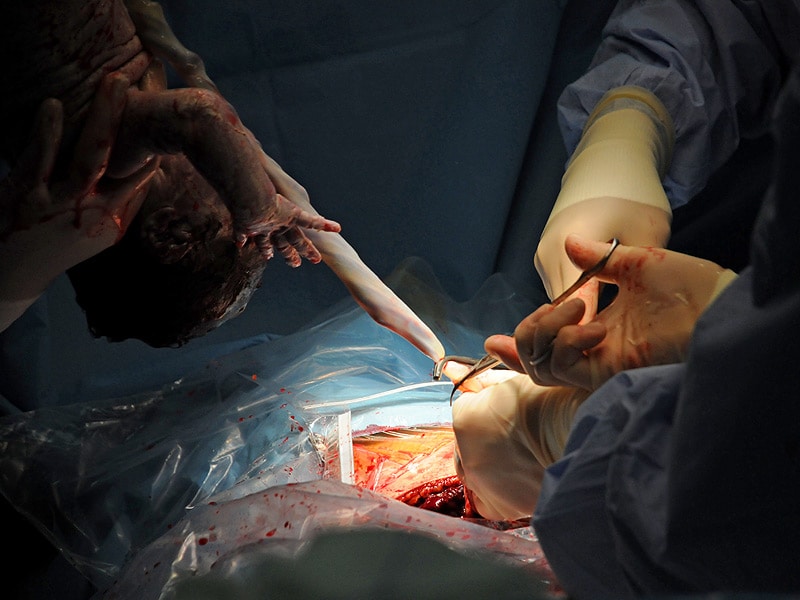 Cesarean Complications Lower With Poliglecaprone 25 Suture
