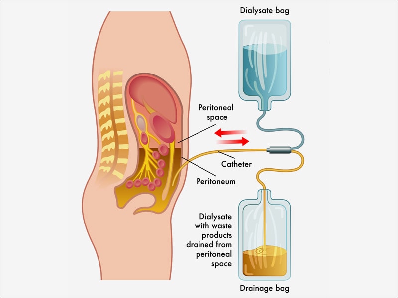 Initiating Peritoneal Dialysis After Catheter Insertion.