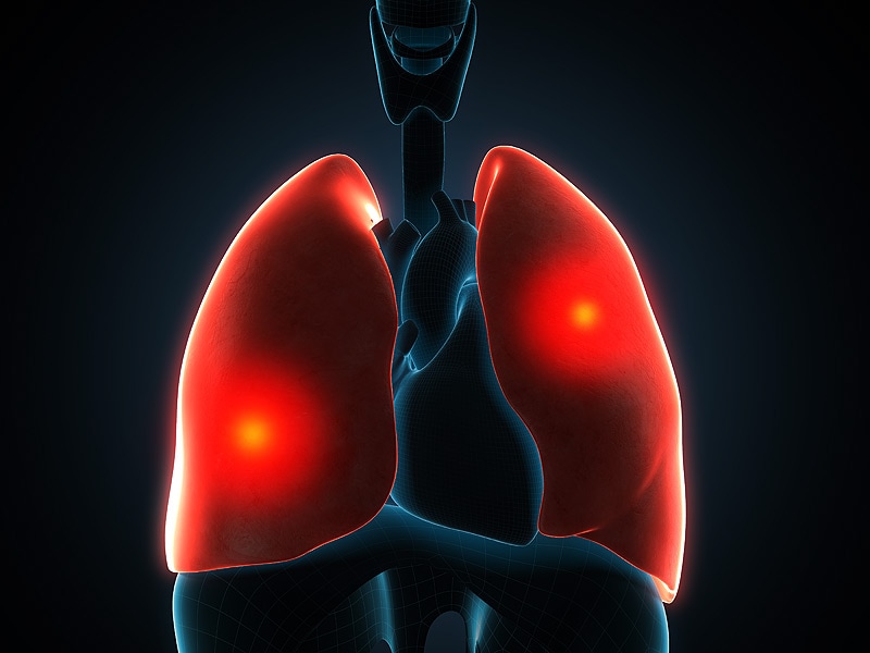 Survival Improving in EarlyStage Lung Cancer