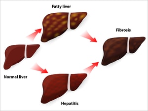 Fatty Liver Common After Direct-Acting Antivirals for Hep C