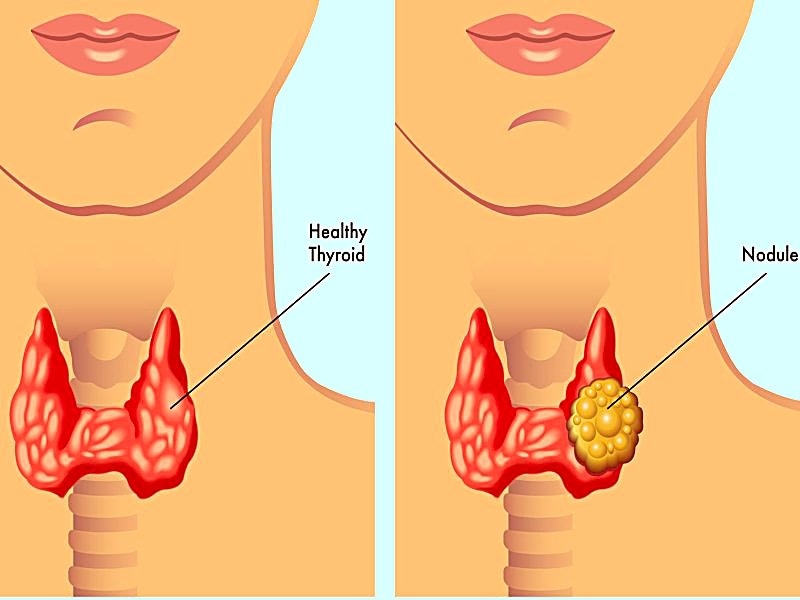 Updated Gene Classifier Test Pinpoints Benign Thyroid Nodules - 