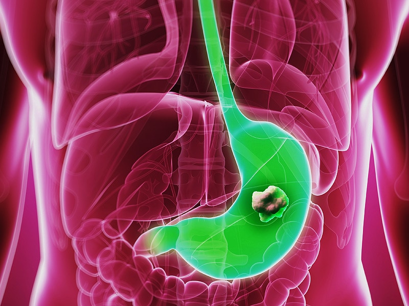 Gastric cancer medscape, Hpv warts medscape