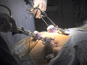 Bariatric Surgery: Many Can Come Off Insulin Long Term
