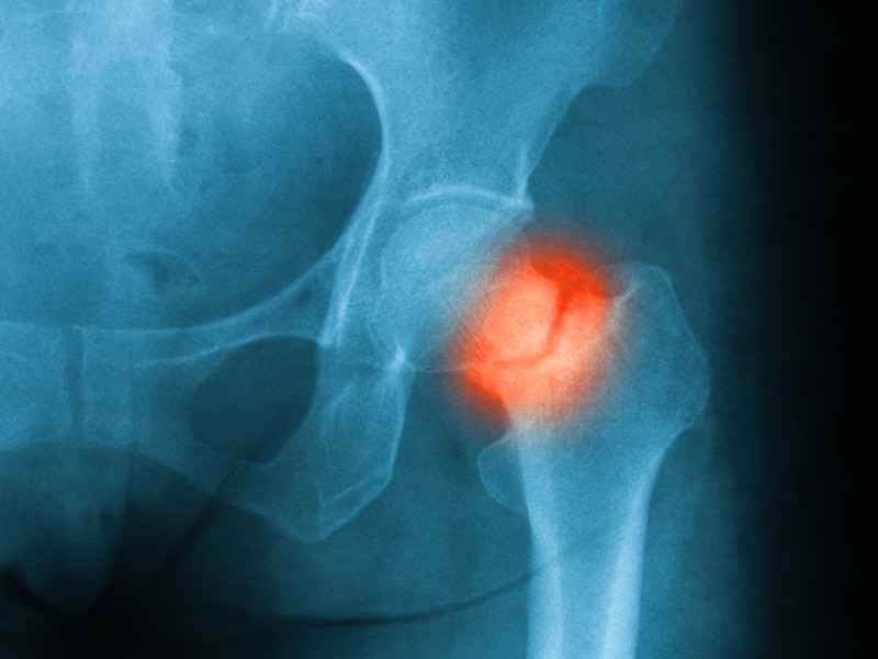 Hip Fracture  Cedars-Sinai