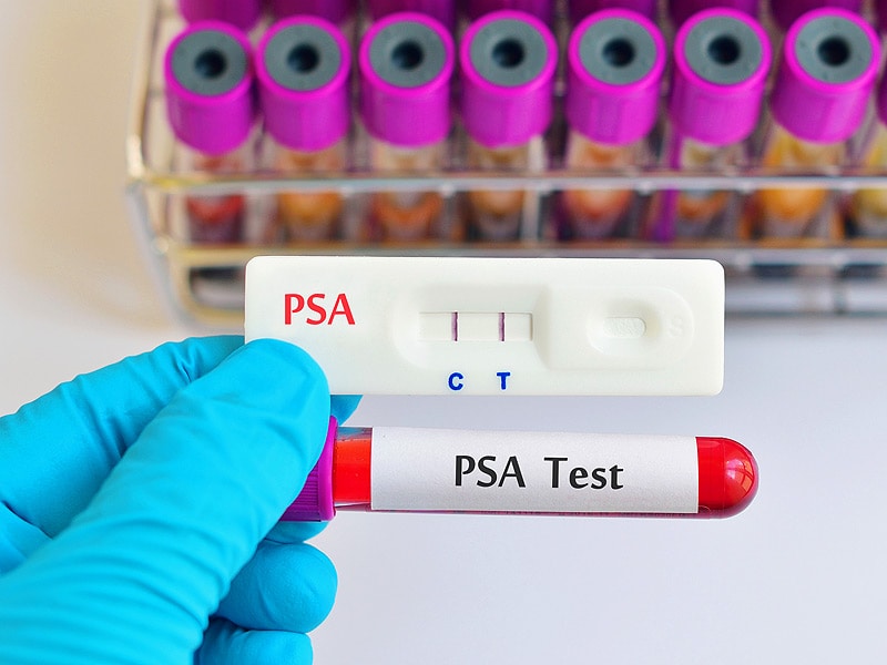 This Gene Test Might Guide PSA Screening Two Views