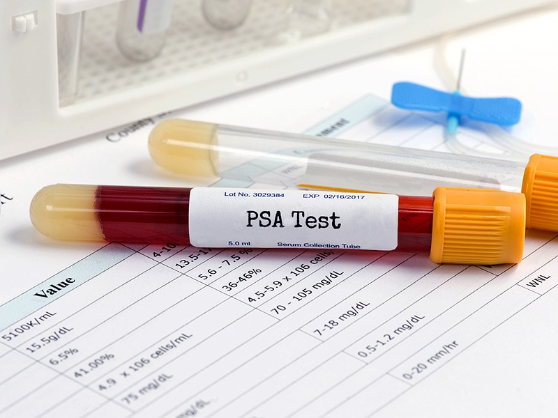 Major Trial: No Mortality Benefit With 'One-Off' PSA Test