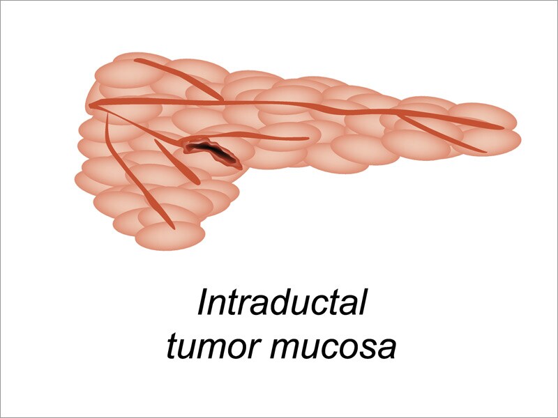 Incidental Pancreatic Cysts Majority Don't Progress to Cancer