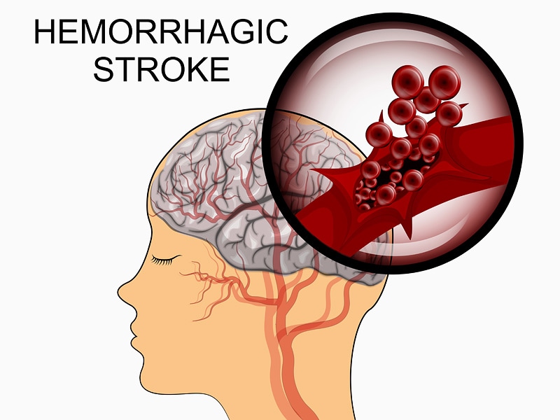 higher-risk-for-repeat-hemorrhagic-stroke-in-minorities