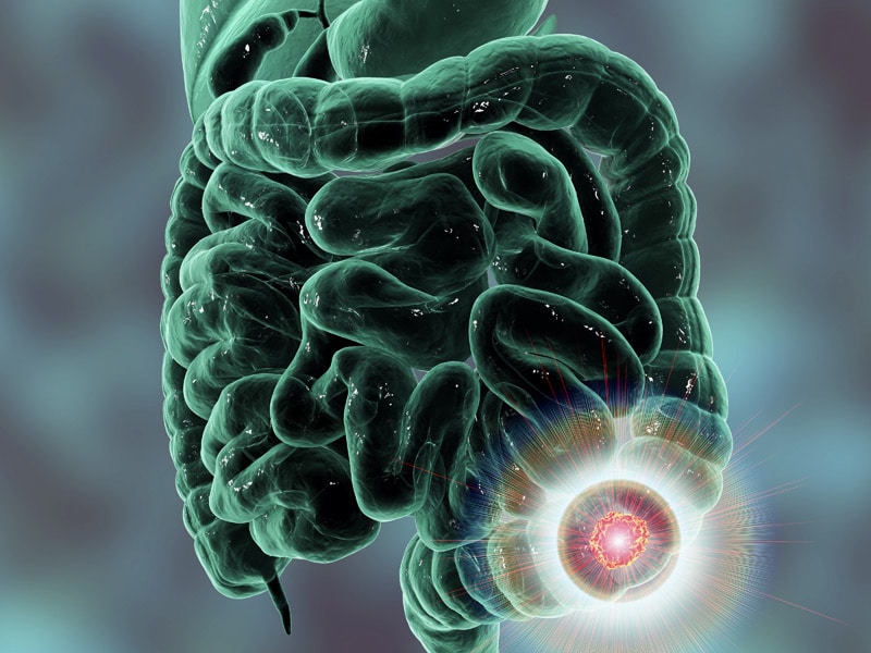 Immunotherapy Disappoints in Metastatic Colorectal Cancer