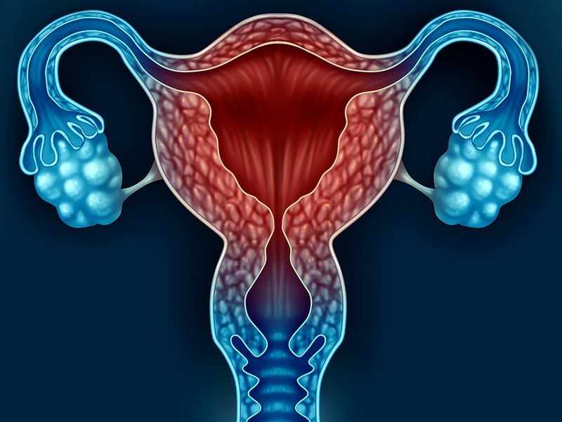 Hysterectomy for Benign Conditions Remove the Ovaries?