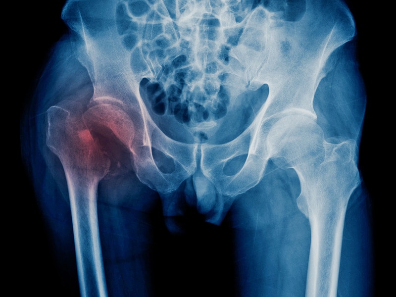 icd 10 code for right hip fracture due to osteoporosis