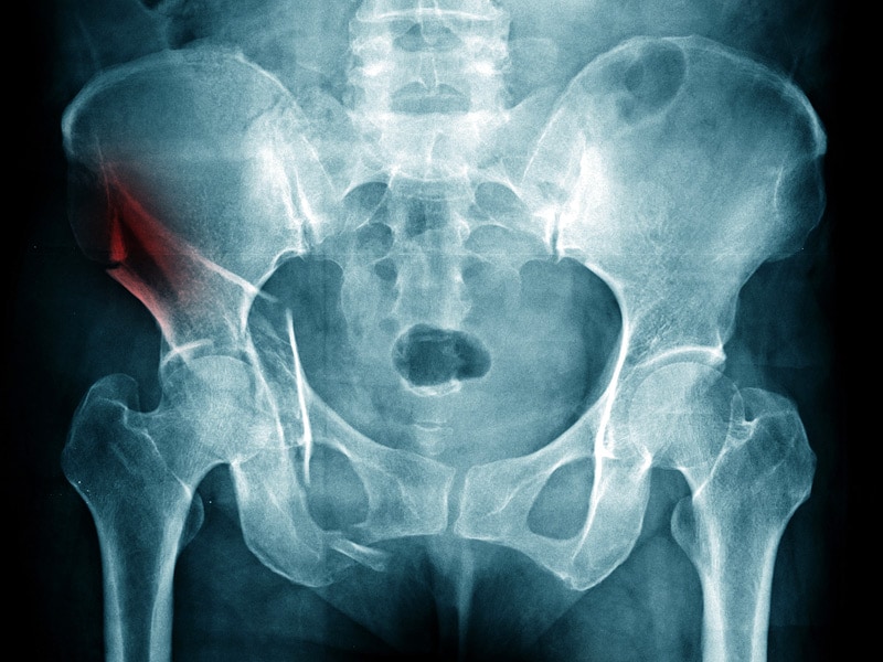 Hip Surgery Delays Increase Mortality Risk in Older Patients