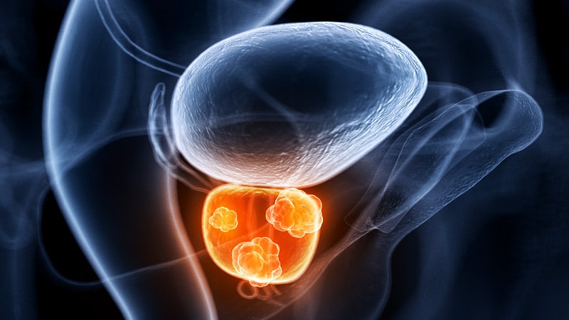 Traitement actif ou observation d’un cancer localisé de la prostate ?