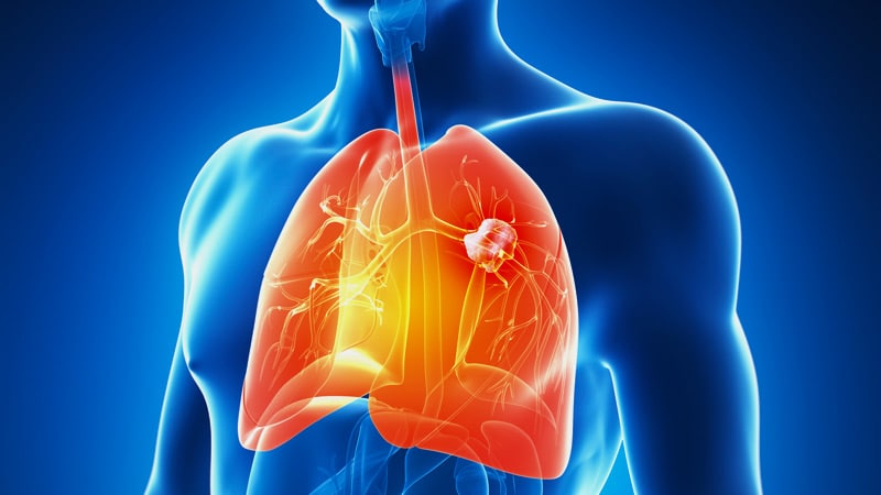 Durvalumab New Standard in Stage III Unresectable Lung Cancer