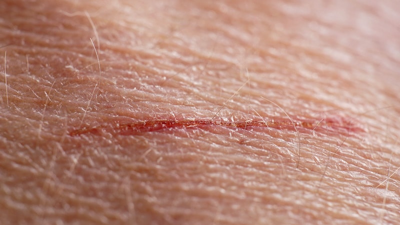 Pathways to Rapid Wound Repair Open Door to Improved Healing