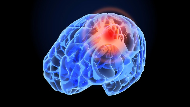 Tirofiban Does Not Improve Outcomes of EVT in Stroke thumbnail