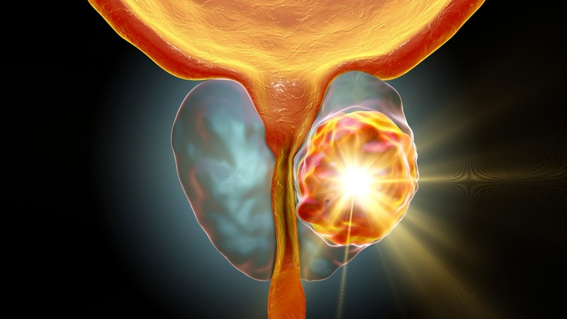 prostate cancer treatment medscape