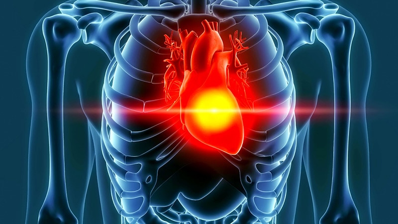 Classification Identifies Four Stages of Heart Attack