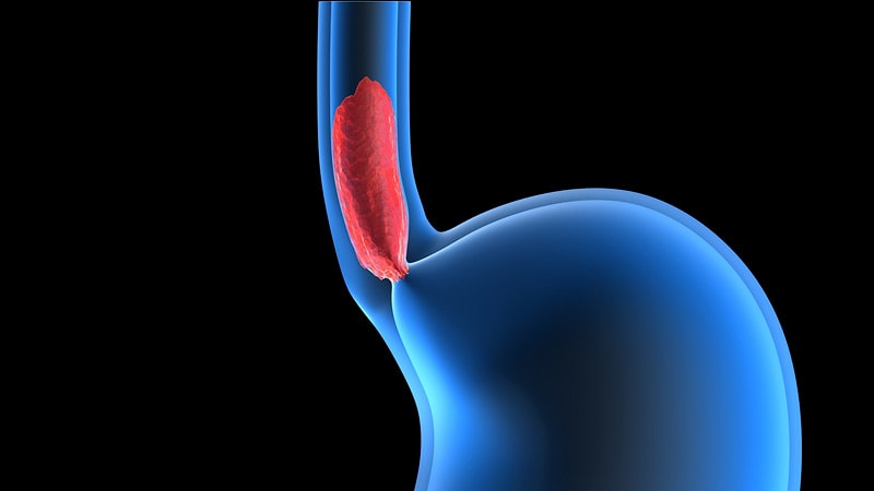 New Standard of Care in PDL1+ Esophageal Cancer?