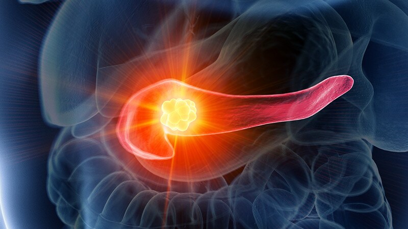 US Task Force Gives Thumbs Down to Pancreatic Cancer Screening