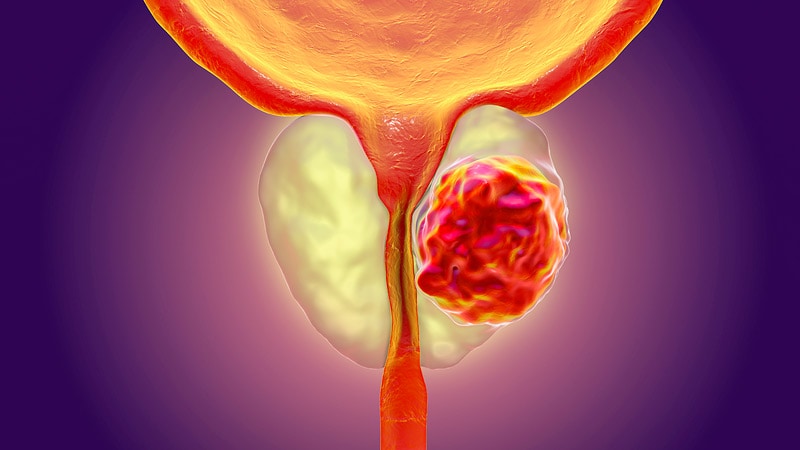 Adding Darolutamide: New SOC for Metastatic Prostate Cancer thumbnail