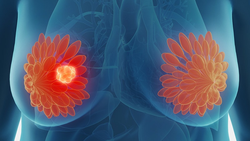SABCS 2023 met en lumière la désescalade du cancer du sein