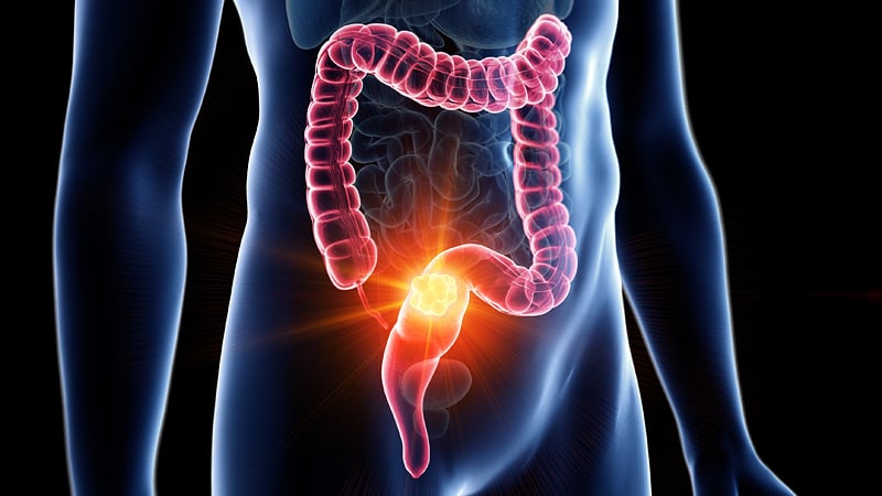 The Good, the Bad, and the Indeterminate in CRC Screening