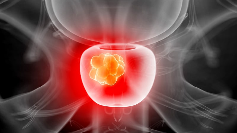 Prostate cancer treatment medscape