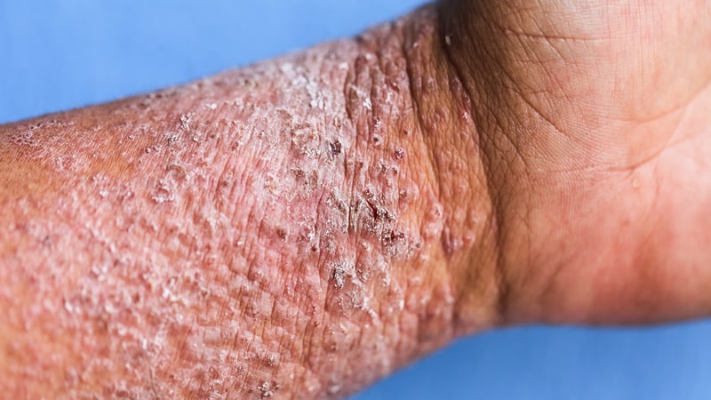 Les risques dermatologiques sont probablement différents pour les inhibiteurs de JAK