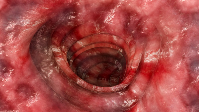 Biologics in IBD: More Thoughtful Use Could Improve Outcomes