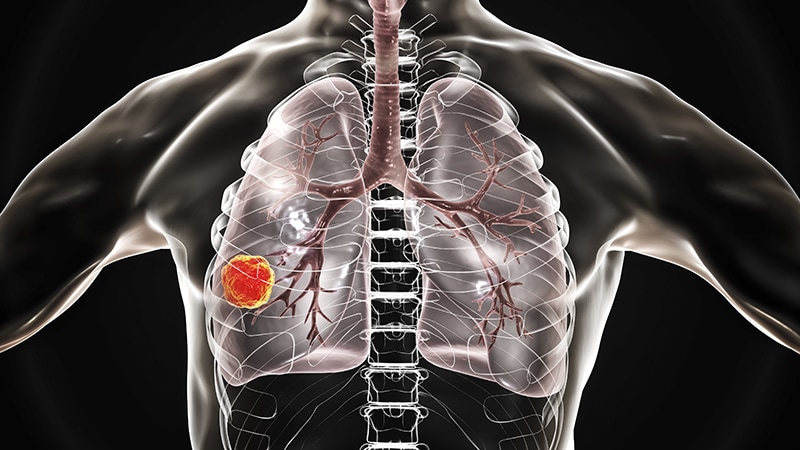 FLAURA Establishes Osimertinib as 1L Therapy in EGFRm NSCLC